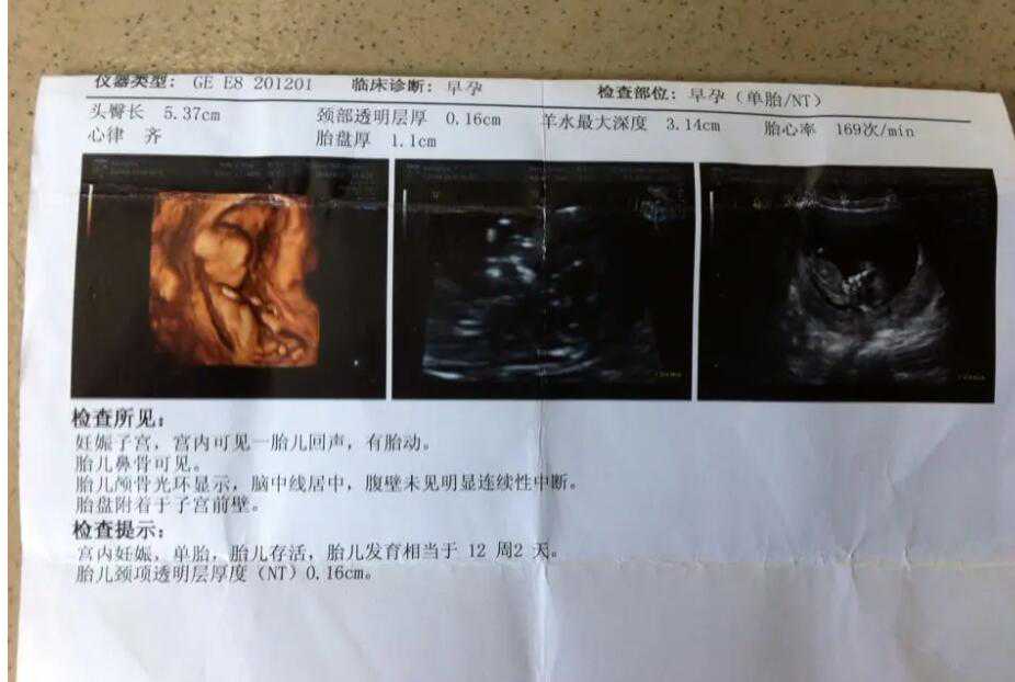 有做代孕的吗_人工代孕介绍_广州试管婴儿取卵流程准备，夫妻双方需知道！